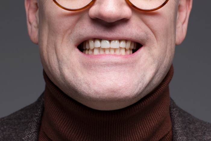 Anders smiler bredt for å vise frem de nye tennene sine. Han er meget fornøyd med resultatet av nye tenner.