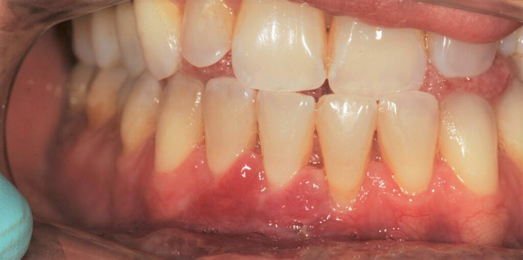 Tannkjøttet er trukket tilbake etter retraksjonskirurgi hos Anders Wangestad ved Oris Dental Løkketangen i Sandvika.